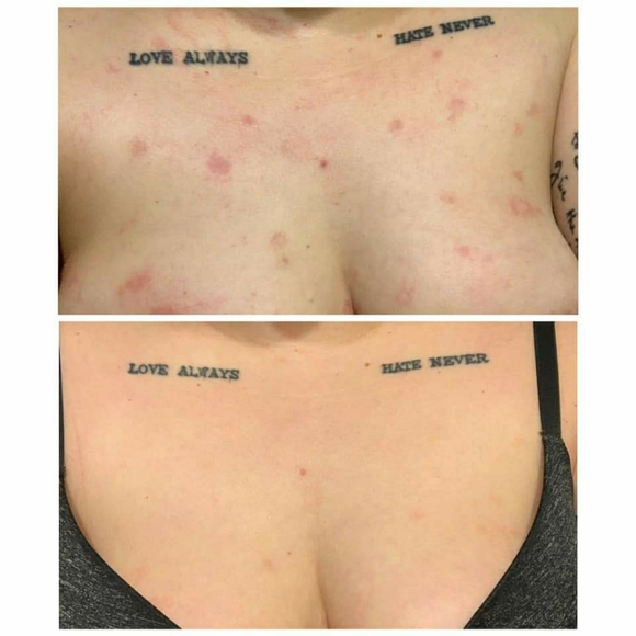 PREORDER ONLY ByeBye Stretch Marks,Mosquitos,Burns - Picture 16 of 16